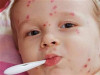 کودکان زیر ۵ سال واکسیناسیون سرخک را تکمیل کنند