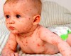 وضعیت بحرانی سرخک | ضرورت تزریق واکسن سرخک کودکان زیر 5 سال